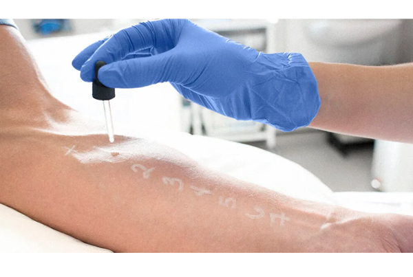 Allergy Testing