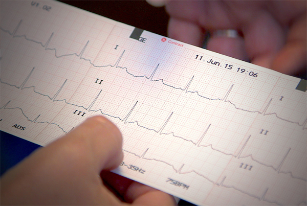 ECG